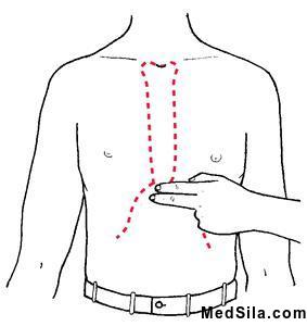 Мечевидный отросток