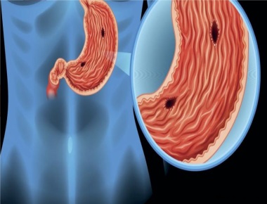 Язва желудка